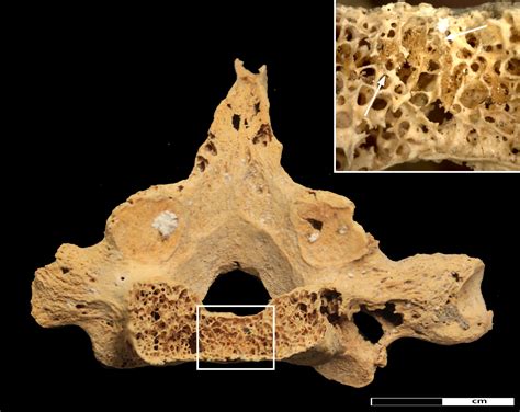 What about vitamins or diets that friends tell me about? Possible Oldest Cancer Found In 3,000-Year-Old Skeleton ...