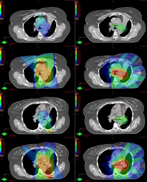 Radiation Therapy For Locally Advanced Lung Cancer Bernard