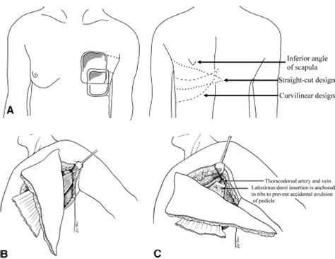 Use Of The Extended V Y Latissimus Dorsi Myocutaneous Flap For Chest