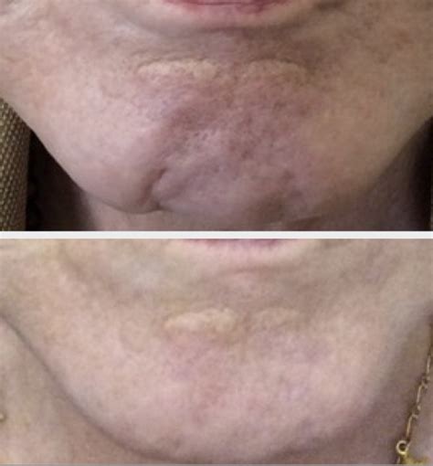 Dr Teri Treats Chin Wrinkles With Botox Chin Tox In Her Cheshire Clinic