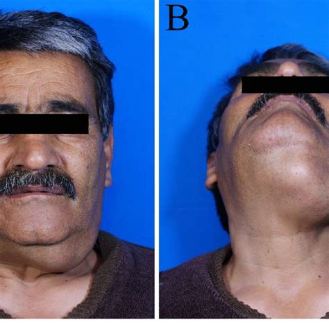 Extraoral Photographs Show A Swelling On Left Side Of Mandible