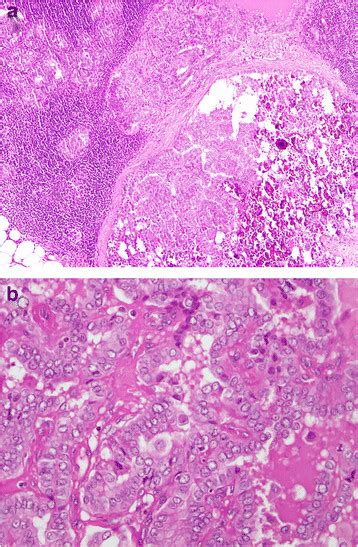 Lymph Node Showing Metastatic Deposits B Tumor With Intranuclear