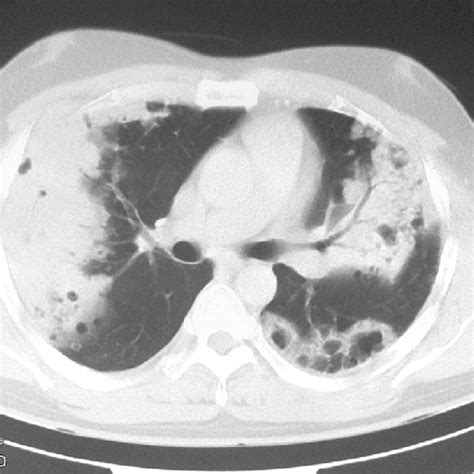 Ct‑chest Showing Left‑sided Pneumothorax With Bilateral Consolidation