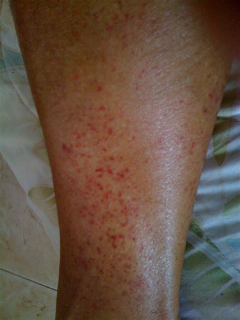 Dark Red Rash On Lower Legs Printable Templates Protal