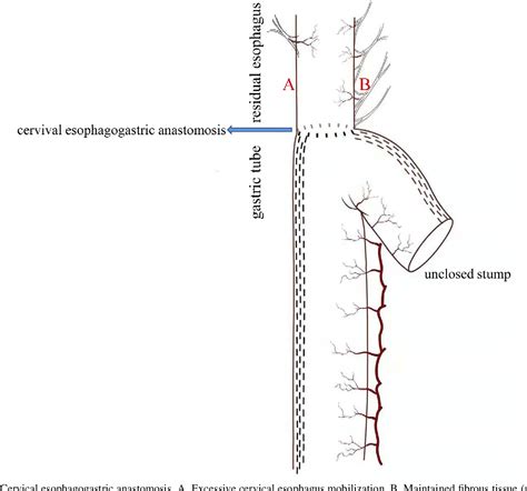 Figure 1 From Length Of Naked Residual Esophagus And Correlation With