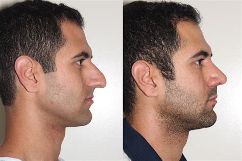 Right Lateral View Open Rhinoplasty Dr Andrew B Denton Vancouver