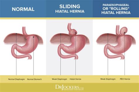 Hiatal Hernia Symptoms Causes And Natural Support Strategies In 2020