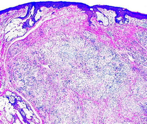 Neuroma Histology