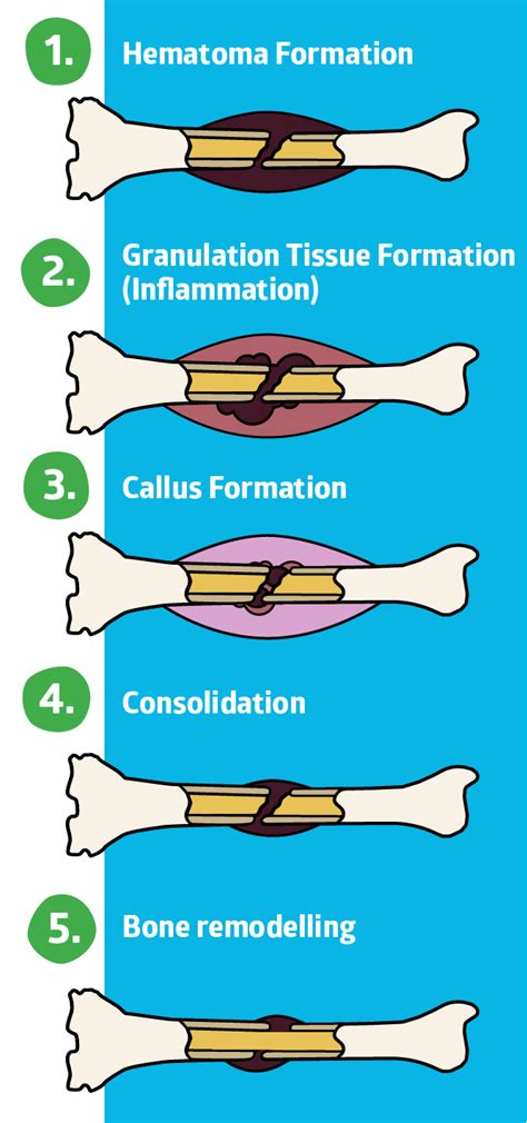 Stages Of Bone Fracture Healing
