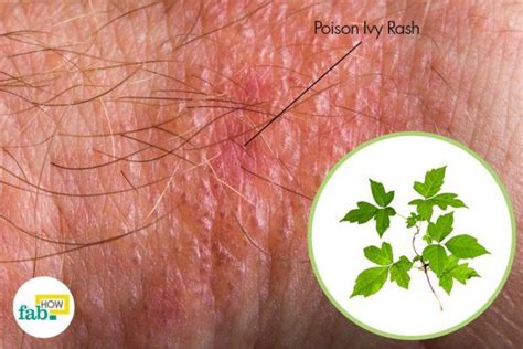 What Is The Treatment For Poison Ivy Rash