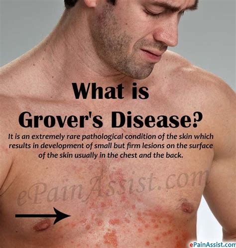 Grovers Disease Is An Extremely Rare Pathological Condition Of The