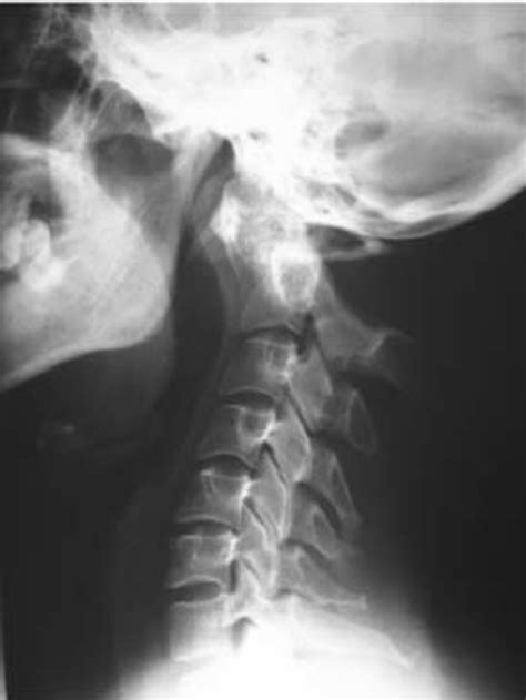 Plain X Rays In Lateral Projection Of The Cervical Spine That Shows C2