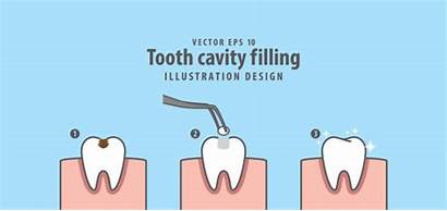 Filling Dental Cavity Vector Tooth Illustration Step