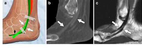 High Resolution Us And Mr Imaging Of Peroneal Tendon Injuries My Xxx Hot Girl