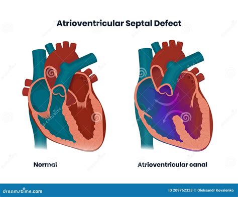 Defecto Septal Auriculoventricular Ilustración De La Anomalía Cardiaca