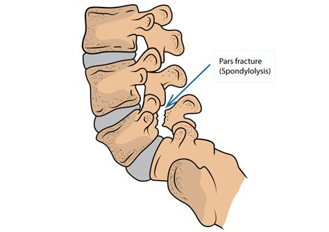 Pars Fracture Lumbar Spine