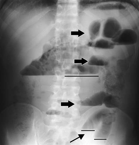 Bowel Obstruction Mesothelioma