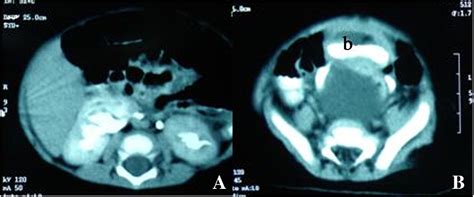 Figure 1 from Laparoscopic management of müllerian duct cysts in