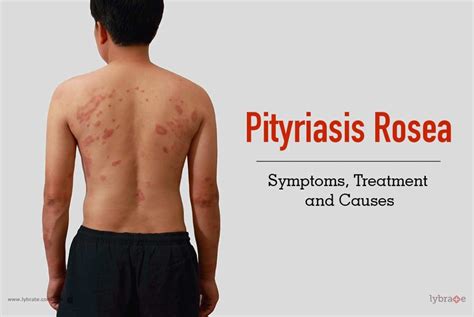 Pityriasis Rosea Symptoms Treatment And Causes By Dr Sandesh Gupta Lybrate
