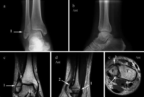 Ap A And Lateral B Radiographs A Transverse Fibular Malleolar