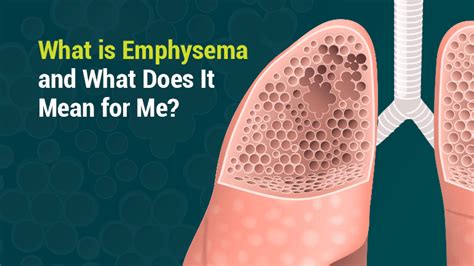What Is Emphysema Teroes