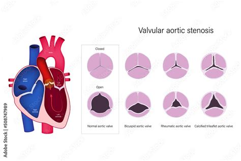 Vetor De Valvular Aortic Stenosis Normal Aortic Valve Bicuspid Aortic Valve Rheumatic Aortic