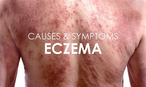 Eczema Causes Symptoms And Treatments Premier Clinic