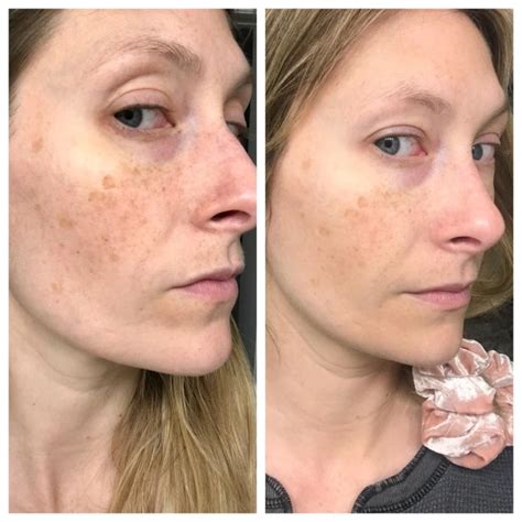 The Ordinary Skincare Before And After The Ordinary Skincare Exposed