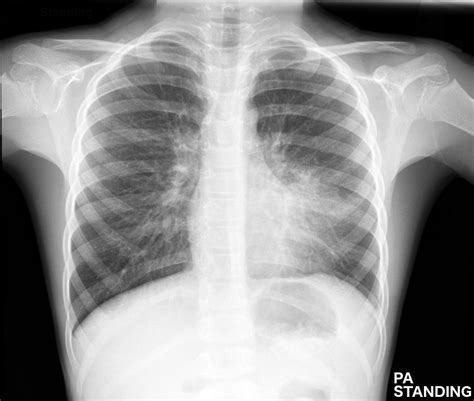 Some lung pathology causes symmetrical changes in the lung fields, which can make it more difficult to recognise, so it's important to keep this in mind (e.g. Booklet: Lung Pneumonia X Ray Vs Normal