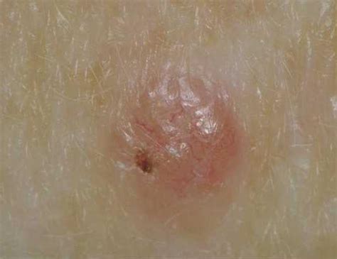 Basal Cell Carcinoma Of The Skin Skin Cancer Information Myvmc
