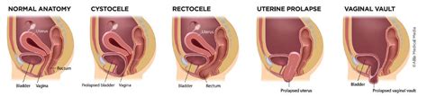 Urogynecology Pelvic Reconstructive Surgeons Located In Akron Oh