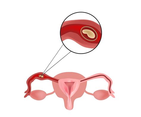 What Is Ectopic Pregnancy? Tubal Pregnancy | familydoctor.org