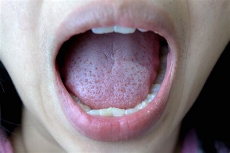 Treating Your White Tongue Properly Shinagawa Dental Blog