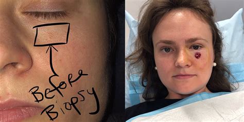 Woman 24 Thought Spot Under Eye Was A Pimple — It Turned Out To Be Skin Cancer Artofit