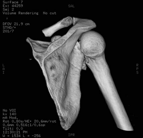 For this reason, you want to reduce the shoulder as soon as possible. Posterior Shoulder Dislocation • LITFL Medical Blog • Trauma