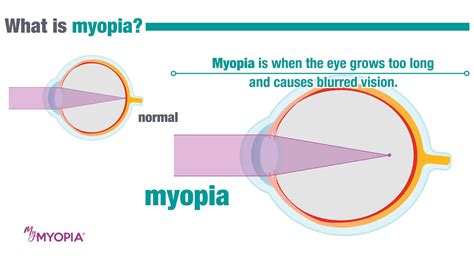 Myopia Treatment For Children In Chicago Eye Society