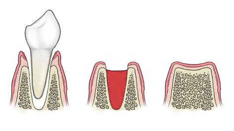 It can take up to a month for the gums to completely heal from a molar tooth being pulled. How Long Does it Take the Hole to Close after Tooth Extraction
