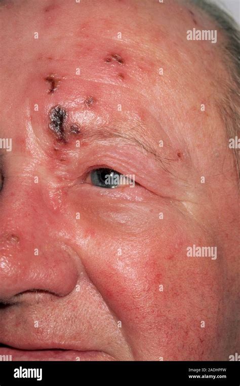Shingles Rash V1 Distribution On The Forehead Of A 72 Year Old Man