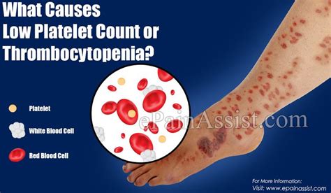 What Causes Low Platelet Count Or Thrombocytopenia Low Platelet