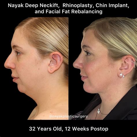 Before And After Deep Necklift Procedures In St Louis Mo Nayak Plastic