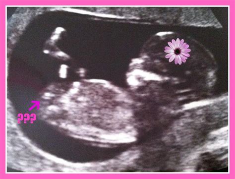 11 Недель Беременности Пол Ребенка Фото Telegraph