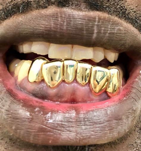 The finished look gives the appearance of a permanent rack of individual gold caps that's just about as boss as you can get. Custom Grillz | Gold Grillz | Diamond Grillz | Custom Jewelry