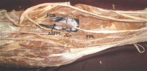 Abfpl Additional Belly Of Flexor Pollicis Longus Fpl Flexor Pollicis Download Scientific