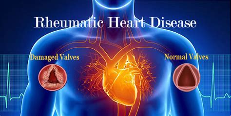 Rheumatic Heart Disease And Its Symptoms In 2020 Disease Heart