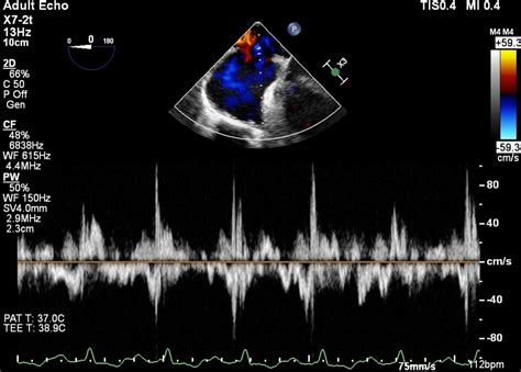 Atrial Septal Defect An Ecg May Show The Crochetage G