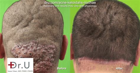 Treating Large Acne Keloidalis Nuchae Bumps With Drus Innovative