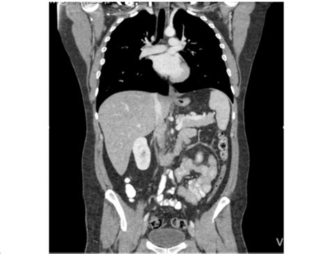 Ct Scan Of Chest Abdomen And Pelvis With Contrast Ct Scan Machine My