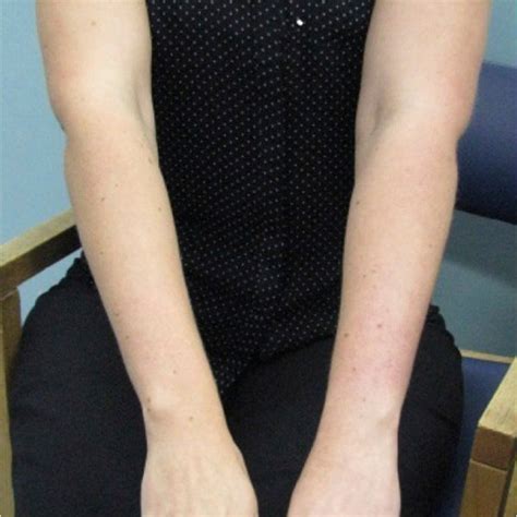 Subtle Arm Swelling And Discoloration Associated With Subclavian