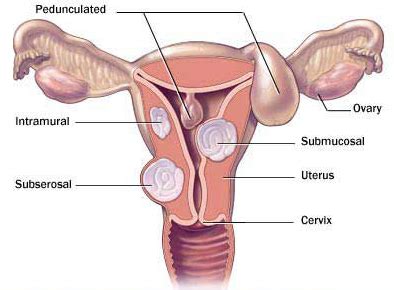 Pada mastalgia yang dipengaruhi oleh nyeri ini terus berlanjut hingga haid tiba. Obat Herbal Untuk Mengobati Kista Rahim ~ Obat Tumor Jinak ...