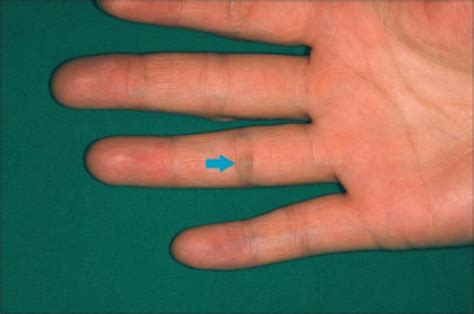Localized Slightly Bluish Papule On The Palmar Area Of Open I